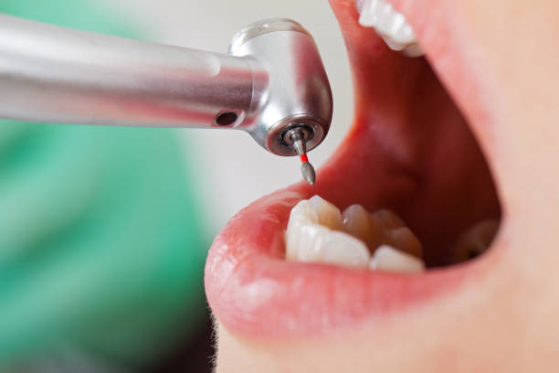 Best Emergency Dental Care for Abscessed Tooth in Circleville, OH